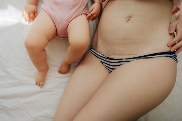 Une mère avec une cicatrice de césarienne avec son bébé (image d'illustration).