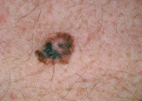 A variety of colours within the same mole is a warning sign to look out for.