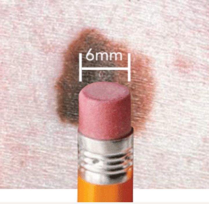 Melanomas tend to be larger than a pencil eraser in diameter, but can be smaller. 