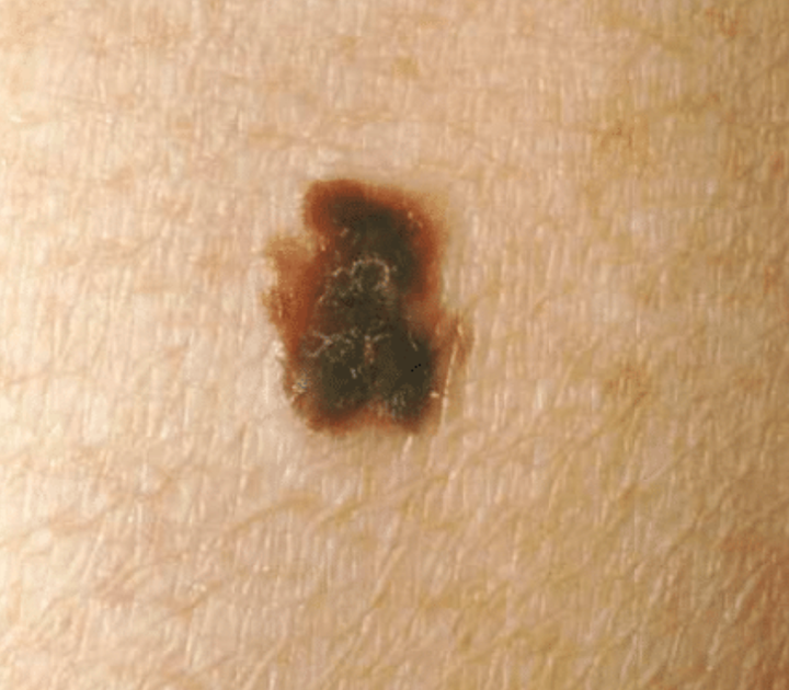 A mole with an irregular border may have scalloped or notched edges. 