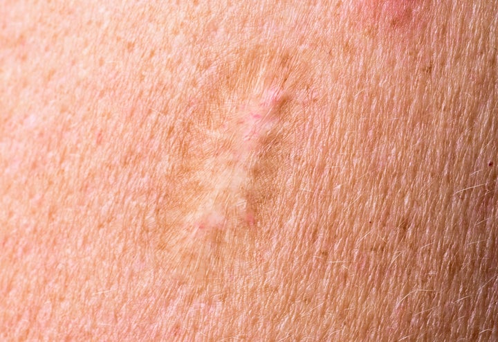 A scar from a smallpox vaccination is visible on an upper arm. Smallpox was long considered one of the most dangerous diseases for humans.
