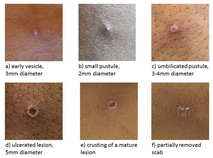 The stages of monkeypox lesions, according to the UKHSA