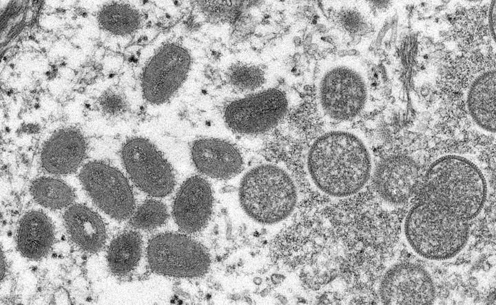 Monkeypox virus particles are seen in an electron microscopic image. The virus can spread when there is close contact with the lesions of someone who is infected.
