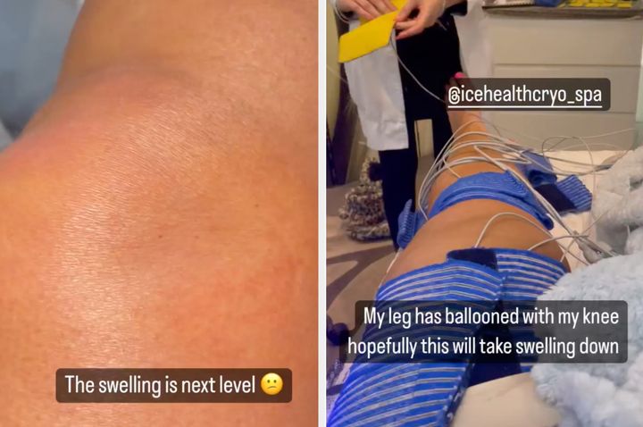 Gemma underwent cryotherapy on her knee on Tuesday