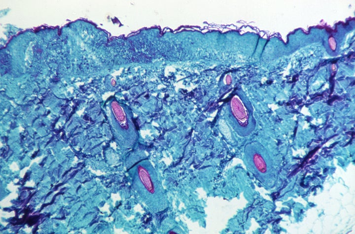 Tejido infectado con la viruela del mono