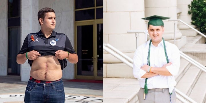 Drew Pescaro shows his scars from the shooting. To the right, Pescaro at graduation last year.