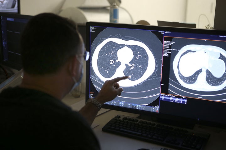 Un radiólogo examina las pruebas realizadas a un paciente diagnosticado de cáncer de pulmón, en una foto de archivo.
