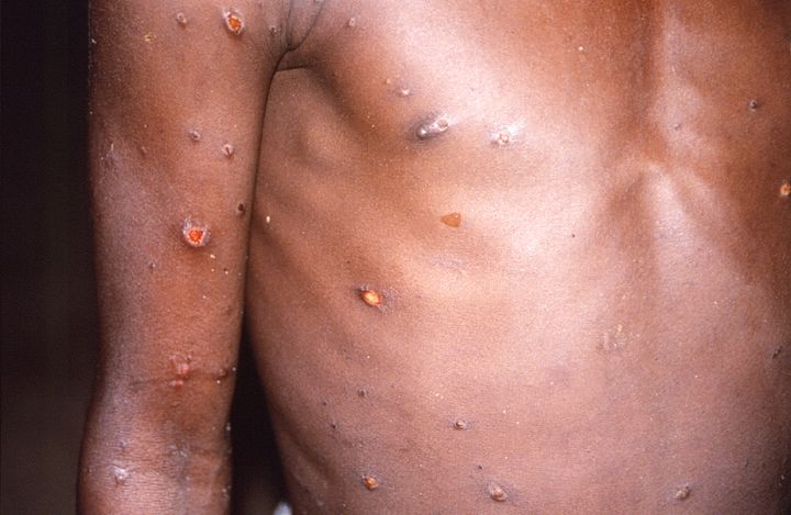 A monkeypox patient is seen in a 1997 photo. The rare viral illness begins with fever, headache, muscle aches and exhaustion and follows with a rash, often starting on the face and then spreading to other parts of the body.