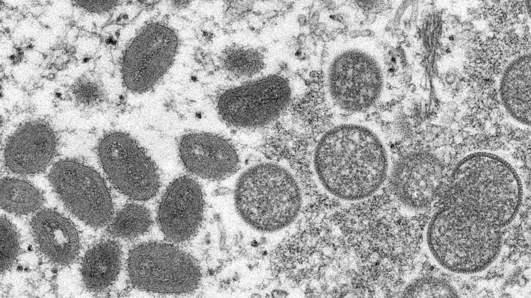 There May Be 2 Distinct Strains Of Monkeypox Circulating In The U.S.
