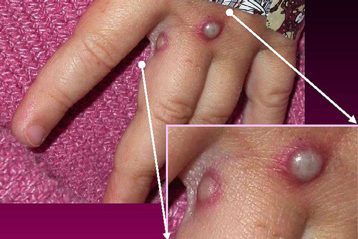 Monkeypox symptoms on a patient's hand