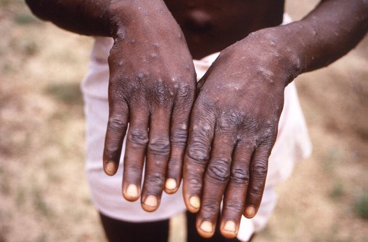 A photo of monkeypox lesions