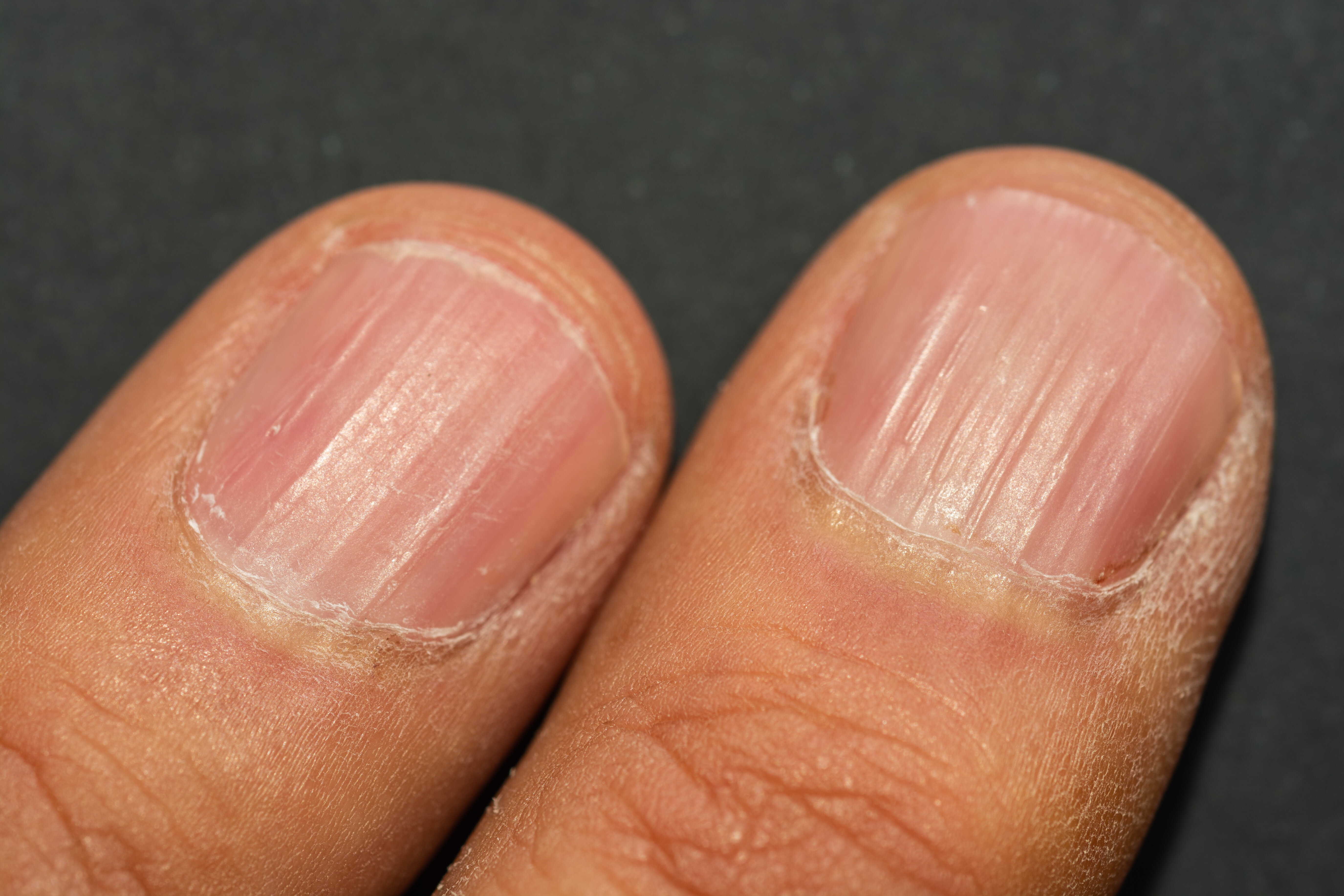 Vertical Ridges in Fingernails - Nail ridges: causes, aging & health! |  Fingernail health, Nail health, Body health