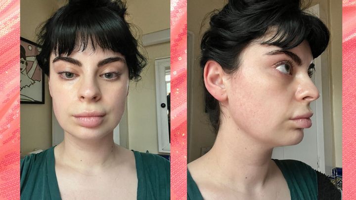 My fresh-out-of-bed skin shows concentrated redness and irregular texture along my cheek and jawline, as well as discoloration beneath my eyes.