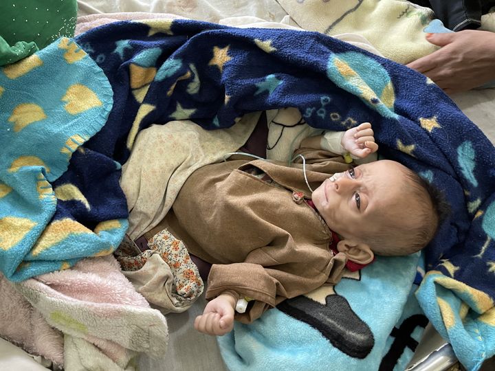 Un niño desnutrido, tratado en un hospital de Kandahar.