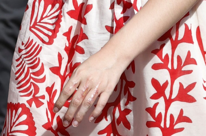 Las heridas de Leonor en la mano.