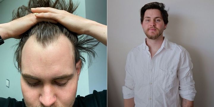 Jan Oliva, 22, got the FUE hair transplant (follicular unit extraction), a procedure where the hair follicles are transplanted from the back of your head to your hairline.