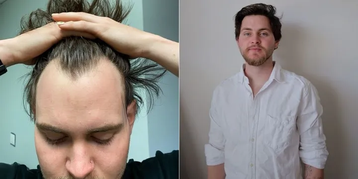 Men Share The Costly Lengths They've Taken To Prevent Balding | HuffPost  Life