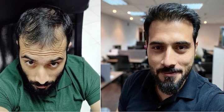 Amir ur Rehman's wife was fine with him balding in his early 20s, but it didn't sit right with him. "Some people suggested I should wear a wig but you’ll never get satisfaction wearing a wig," he said.