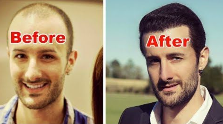 Musician David DiMuzio before and after hair transplants. “Even the scar is covered up by hair, and the hair looks great now,” he told HuffPost.