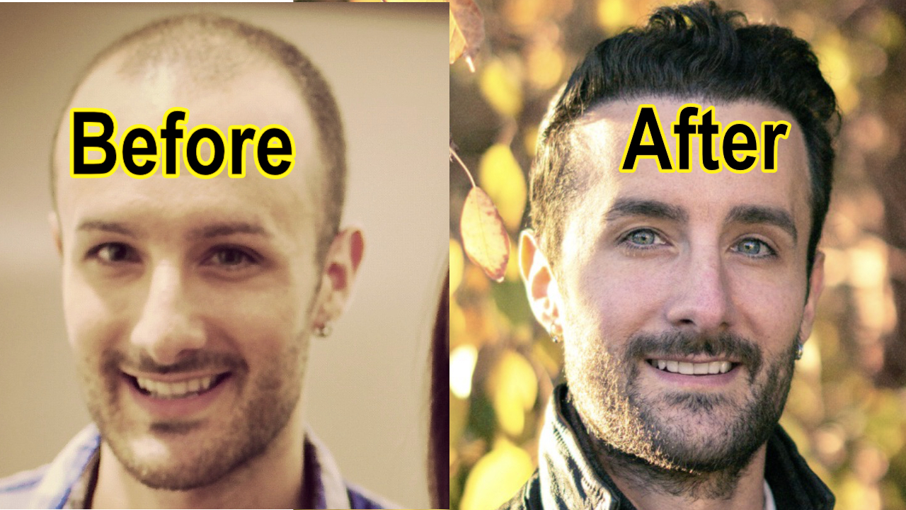 🥇 Beverly Hills Hair Transplant Before and After Pictures, Results