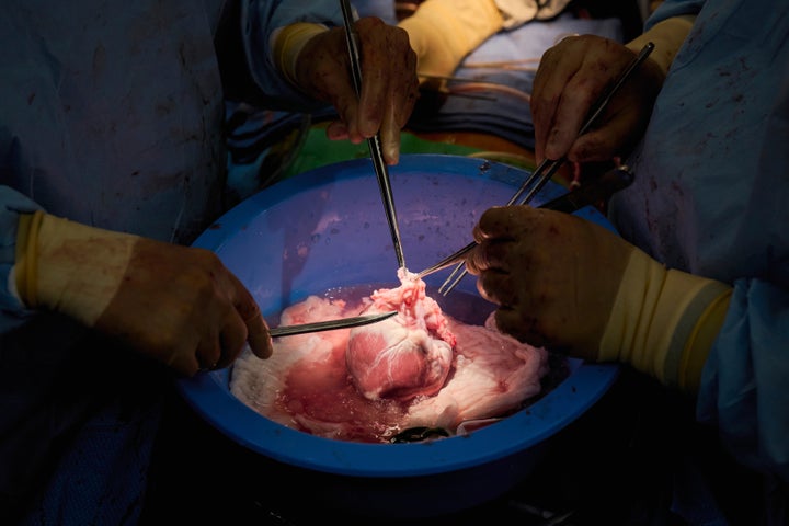 In this photo provided by NYU Langone Health, surgeons prepare a genetically modified pig heart for transplant into a recently deceased donor at NYU Langone Health on Wednesday, July 6, 2022, in New York. Experiments are raising new hope that pigs might one day help fill a shortage of donated organs -- at least, for people who need a new heart or kidney. (Joe Carrotta/NYU Langone Health via AP)