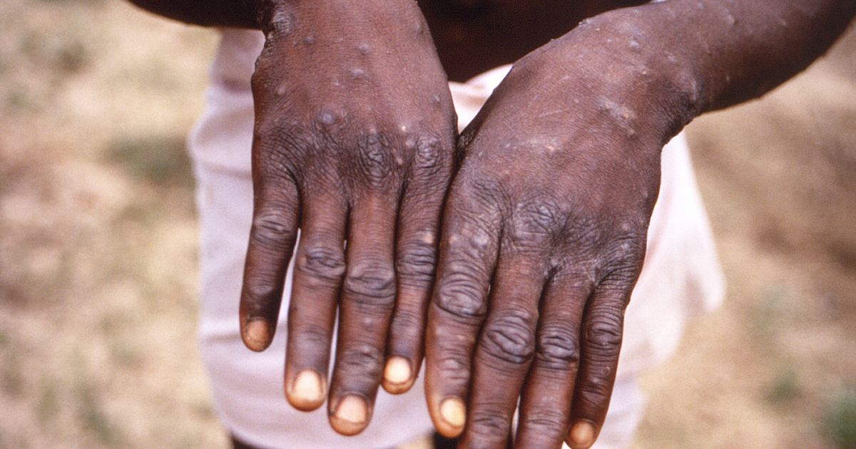 UN Health Agency Declares Monkeypox A Global Emergency