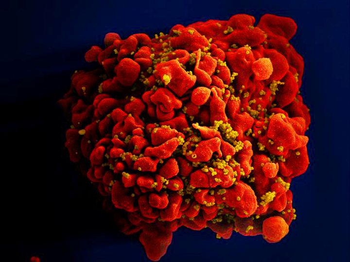 Μια ψηφιακά χρωματισμένη ηλεκτρονική μικροσκοπική εικόνα σάρωσης απεικονίζει ένα μοναδικό, κόκκινου χρώματος κύτταρο H9-T που είχε μολυνθεί από πολυάριθμα σωματίδια ιού ανθρώπινης ανοσοανεπάρκειας (HIV) σε σχήμα σφαιροειδούς, χρώματος μουστάρδας, συνδεδεμένα στην επιφανειακή μεμβράνη του κυττάρου.