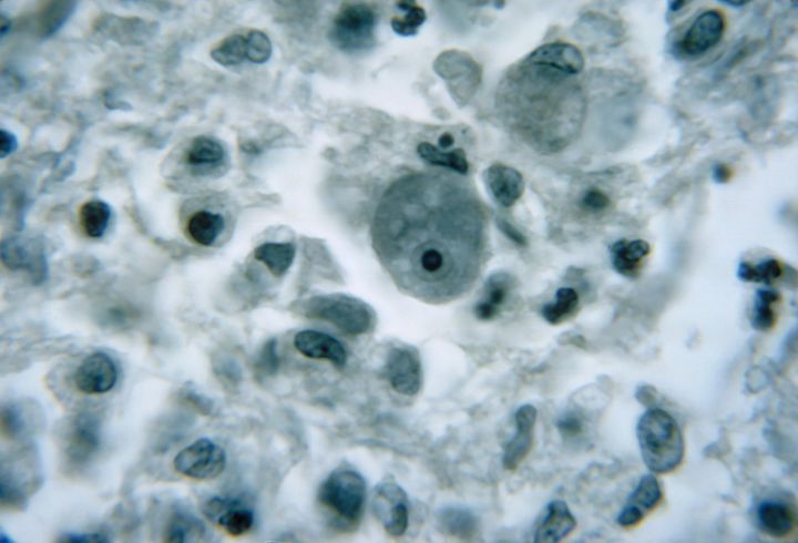 Δείγμα εγκεφαλικού ιστού που έχει προσβληθεί από την αμοιβάδα με την ονομασία Naegleria fowleri.