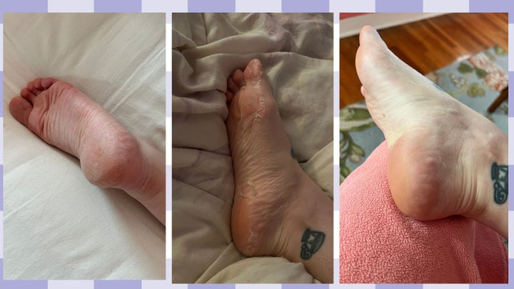 Left: My dry rough heels prior to using the treatment; Center: About a week after I used the mask at the height of peeling. Right: About two weeks after the mask when most of the peeling had stopped.