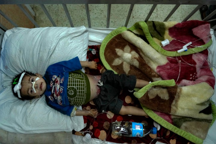 Un niño malnutrido recibe tratamiento en el hospital Indira Gandhi de Kabul, el pasado 18 de mayo.