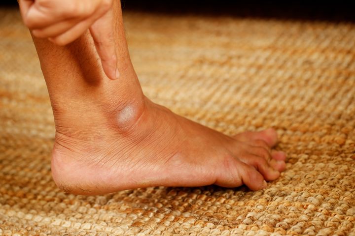 Gout flare-ups most commonly occur in the big toe, knee and ankle.