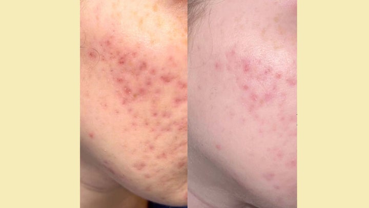Left: Before use; Right: After two weeks of using the scar gel, according to the brand.
