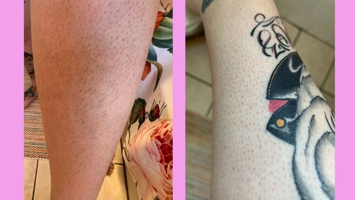 Left: My left leg after one week without shaving and without applying the hair-minimizing lotion. Right: My right leg after one week of shaving after applying the hair minimizing lotion every day.