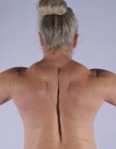 The author's back and shoulders in 2009, two years after her muscles began growing rapidly.