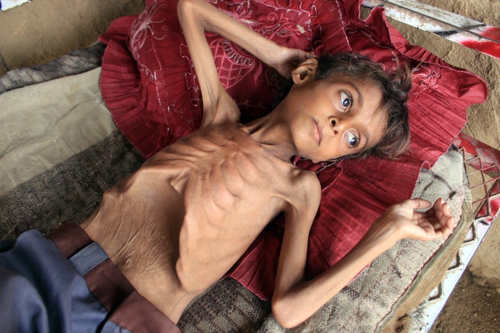 Hassan Razem, de diez años, severamente malnutrido, descansa en una camilla en el distrito de Abs, en Yemen, el pasado julio.