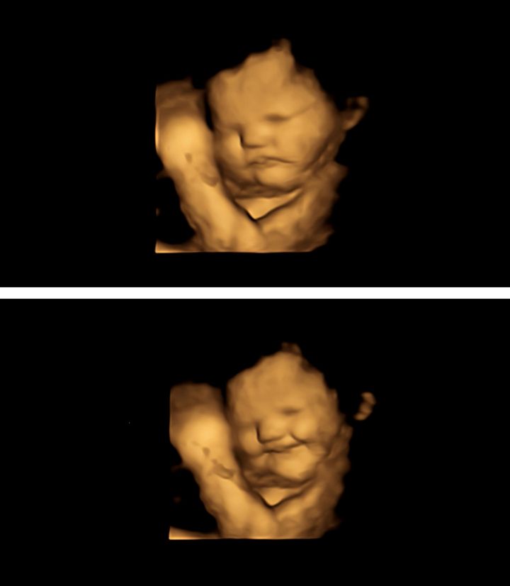 A 4D scan of a foetus showing a neutral face (top) and the same foetus showing a laughter-face reaction (bottom), after being exposed to the carrot flavour.