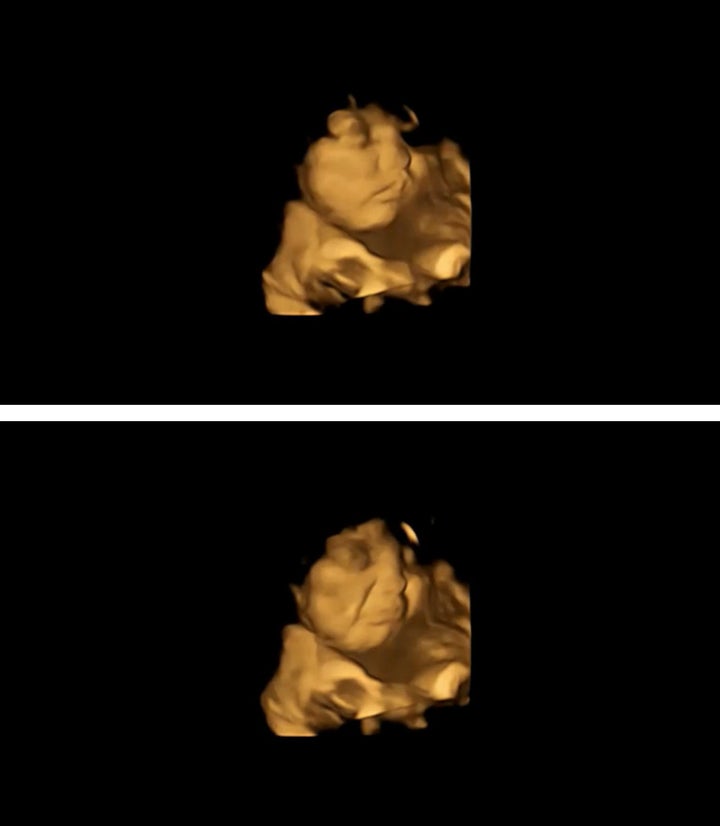 A 4D scan of a foetus showing a neutral face (top) and the same foetus showing a cry-face reaction (bottom), after being exposed to the kale flavour.