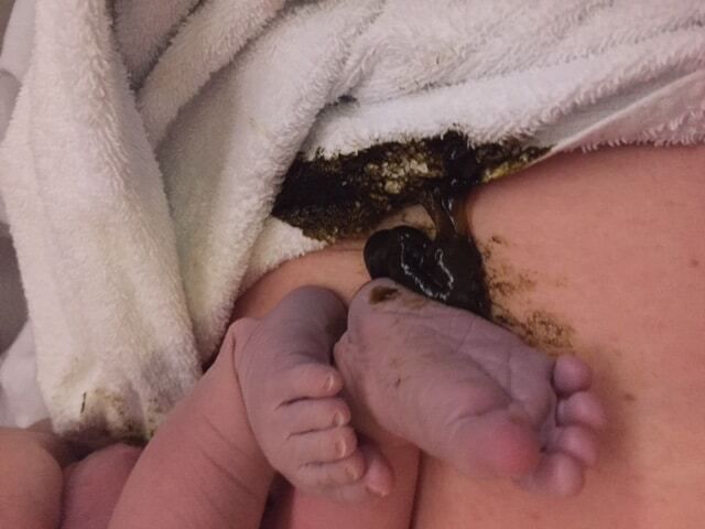 A meconium poo shortly after birth.
