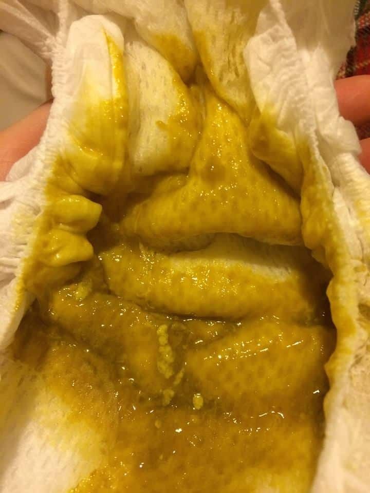 A mucus-filled poo from a baby diagnosed with allergies.