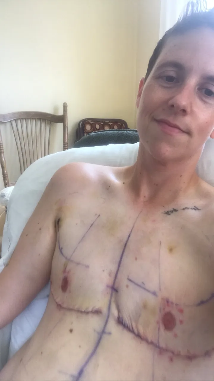 I Had My Breasts Removed. I Didn't Realize It Would Affect Me The Way It  Did.
