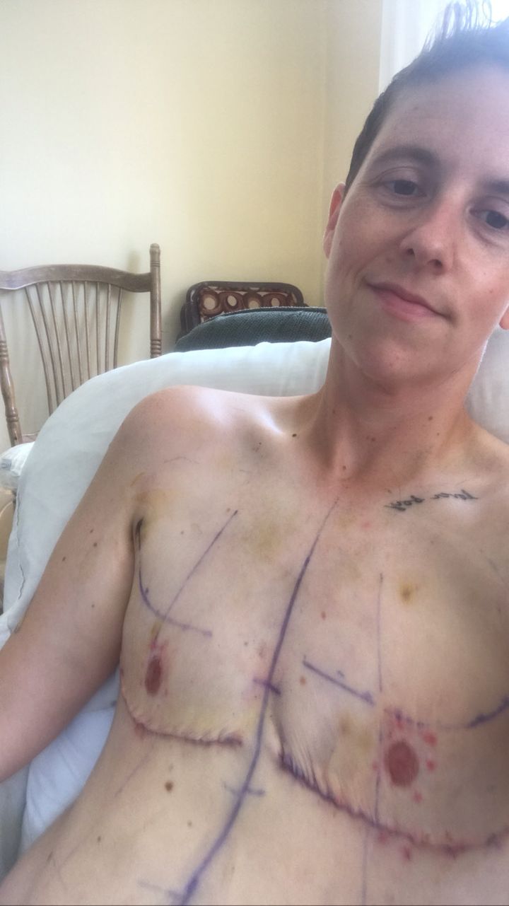 The author after their top surgery.