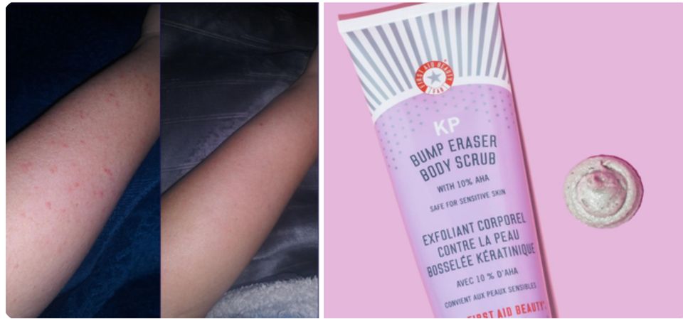 First Aid Beauty's KP Bump Eraser to help exfoliate and smooth skin