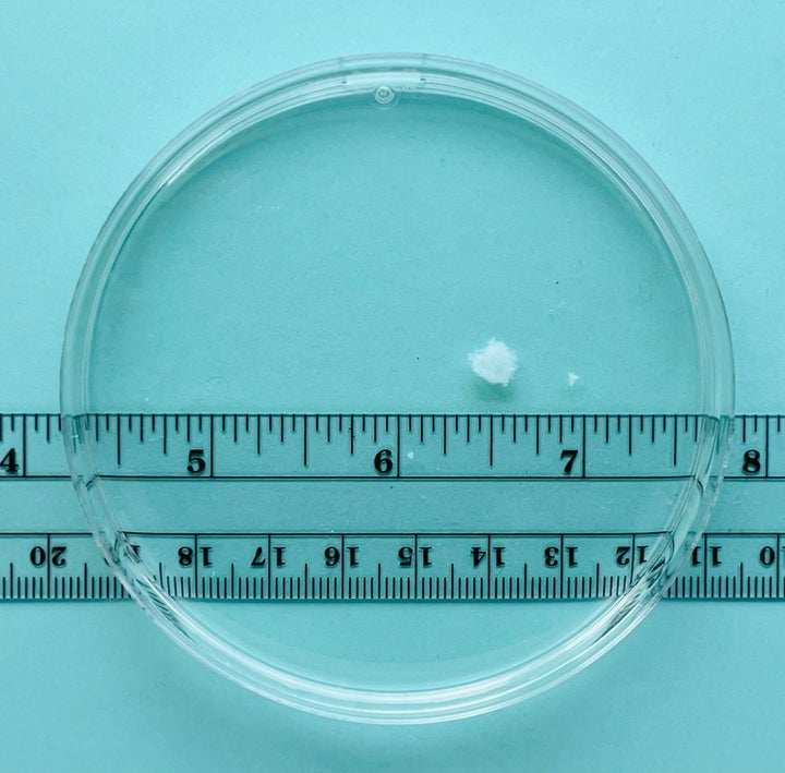 Tissue removed from the uterus at five weeks of pregnancy.