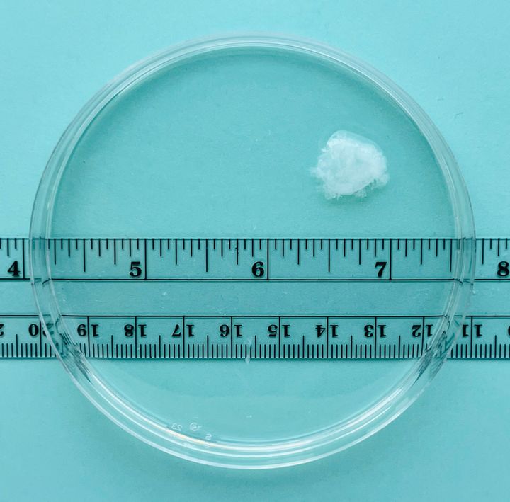 Tissue removed from the uterus at six weeks of pregnancy.