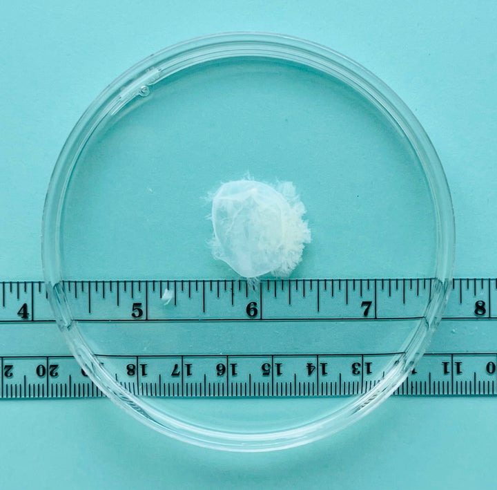 Tissue removed from the uterus at seven weeks of pregnancy.