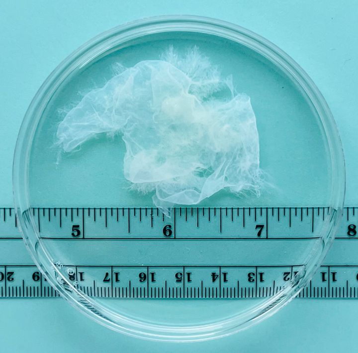 Tissue removed from the uterus at eight weeks of pregnancy.