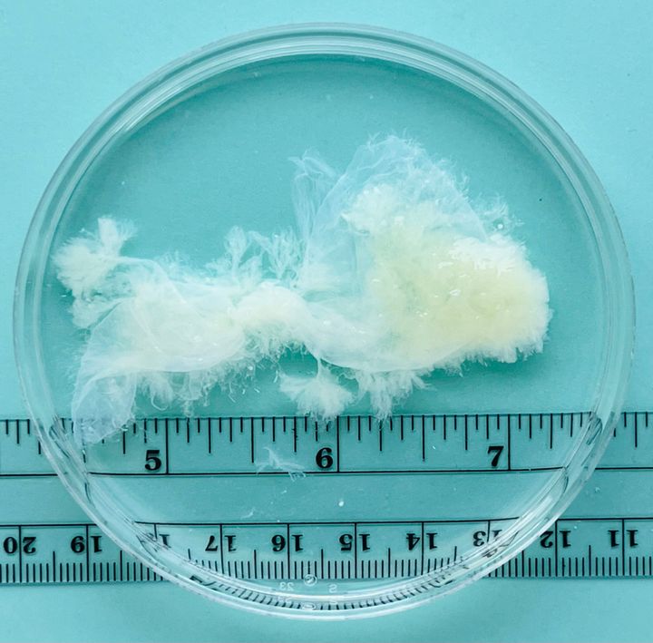 Tissue removed from the uterus at nine weeks of pregnancy.