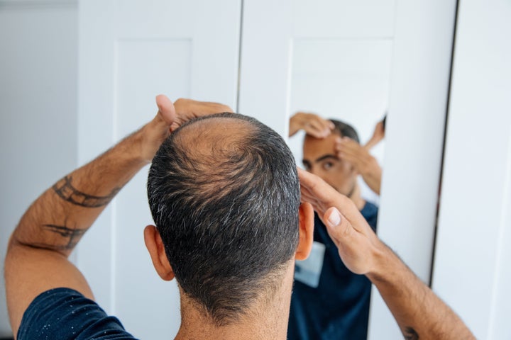 Bald man looking mirror at head baldness and hair loss