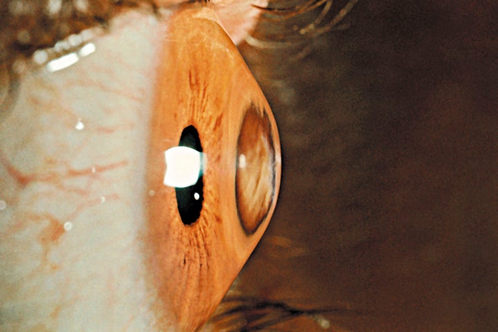 Keratoconus. (Photo By BSIP/UIG Via Getty Images)