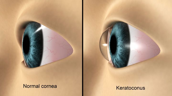Ιατρική απεικόνιση που δείχνει κερατόκωνο στο μάτι. Ο κερατόκωνος είναι μια διαταραχή που οδηγεί σε λέπτυνση του κερατοειδούς.